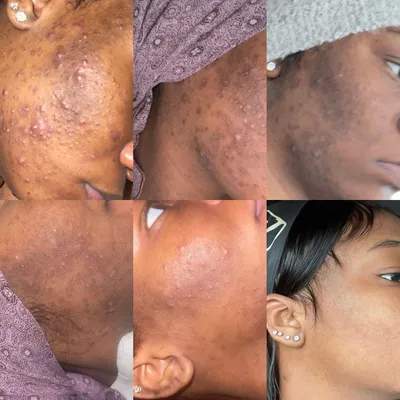 Acne Treatment Facial